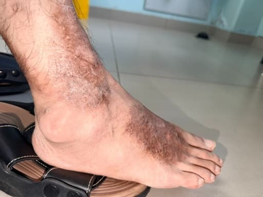 Photograph of a firm, lobulated swelling over the right lateral malleolus, consistent with a gouty tophus